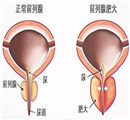 男人包皮过长会引发早泄